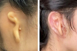 Cient&iacute;ficos reconstruyen una oreja gracias a tejido de c&eacute;lulas humanas impreso en 3D