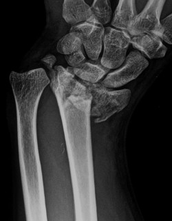 Desarrollan un material para trasplantar c&eacute;lulas madre formadoras de hueso y acelerar la curaci&oacute;n de fracturas graves