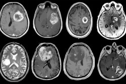 Descubierto nuevo objetivo de inmunoterapia para tumores cerebrales malignos