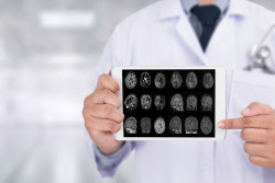 Descubren los mecanismos clave de la degeneraci&oacute;n de las sinapsis en el cerebro con Alzheimer