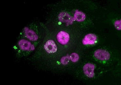 Descubren un nueva v&iacute;a para prevenir la met&aacute;stasis en el c&aacute;ncer de p&aacute;ncreas