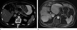 El c&aacute;ncer de h&iacute;gado diez veces es m&aacute;s probable en hombres con hemocromatosis, un trastorno gen&eacute;tico com&uacute;n