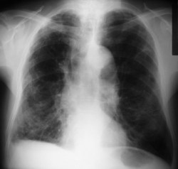 El desarrollo pulmonar puede explicar por qu&eacute; algunos no fumadores contraen EPOC y fumadores empedernidos no