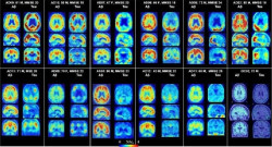 El gen de riesgo de Alzheimer puede quedar compensado por la acci&oacute;n de otro gen