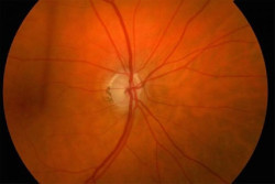 El glaucoma puede ser algo m&aacute;s que un problema de presi&oacute;n ocular