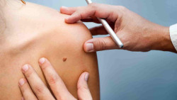 El melanoma ser&aacute; el segundo tumor en incidencia global para 2040, seg&uacute;n los dermat&oacute;logos