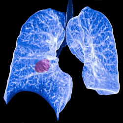 El tipo y abundancia de bacterias bucales, relacionado con el riesgo de c&aacute;ncer de pulm&oacute;n en no fumadores
