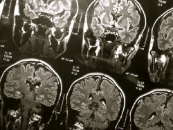 Encuentran una v&iacute;a para abordar el deterioro de la barrera hematoencef&aacute;lica en el Alzheimer
