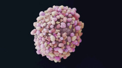 Estudio arroja luz sobre los riesgos de c&aacute;ncer de mama despu&eacute;s de una enfermedad preinvasiva