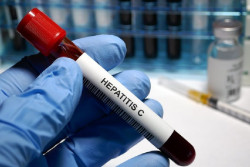 Expertos alertan de que en Espa&ntilde;a m&aacute;s de 26.000 personas todav&iacute;a no saben que padecen hepatitis C
