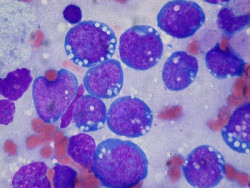 Hallan una nueva opci&oacute;n de tratamiento efectiva y menos t&oacute;xica para adultos con linfoma de Burkitt
