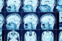 Identifican una nueva v&iacute;a celular que limita el crecimiento y la propagaci&oacute;n de tumores cerebrales