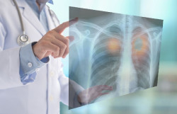 Investigadores alertan de un aumento del c&aacute;ncer de pulm&oacute;n en mujeres no fumadoras