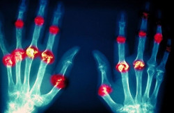 La artritis reumatoide, vinculada a un menor riesgo de diabetes tipo 2