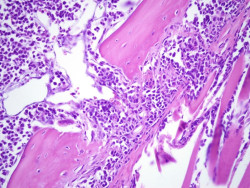 La inhibici&oacute;n de una prote&iacute;na puede reducir el crecimiento de c&eacute;lulas cancerosas en el mieloma m&uacute;ltiple