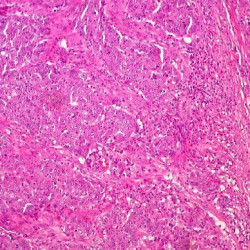 La inmunoterapia puede ser eficaz para pacientes con c&aacute;ncer colorrectal metast&aacute;sico no diseminado al h&iacute;gado
