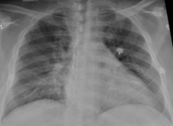  La mayor&iacute;a de los pulmones se recuperan bien tres meses despu&eacute;s del pasar el COVID-19 con gravedad