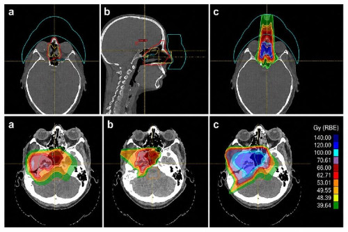 La reirradiaci&oacute;n con protonterapia logra un 67% de supervivencia en c&aacute;ncer de cabeza y cuello, seg&uacute;n un estudio