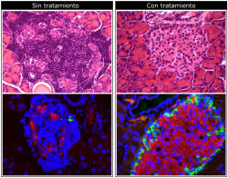 La remisi&oacute;n de la diabetes tipo 2 por la p&eacute;rdida de peso puede restaurar el tama&ntilde;o del p&aacute;ncreas