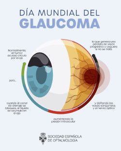 La Sociedad Espa&ntilde;ola de Oftalmolog&iacute;a advierte de que solo la mitad de los pacientes con glaucoma saben que lo padecen