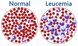 La terapia combinada dirigida para la leucemia linfoc&iacute;tica cr&oacute;nica proporciona supervivencia global a 3 a&ntilde;os del 96%