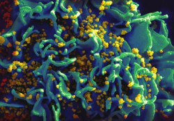 Las c&eacute;lulas cerebrales pueden albergar y propagar el virus del VIH al resto del cuerpo