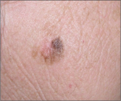 Las c&eacute;lulas expuestas a los carcin&oacute;genos ofrecen pistas para combatir los c&aacute;nceres resistentes al tratamiento