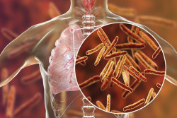 Los cient&iacute;ficos descubren una nueva y sorprendente forma en que la tuberculosis suprime la inmunidad