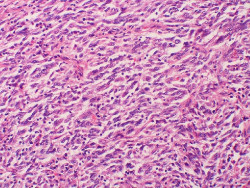 Los investigadores descubren c&oacute;mo potenciar la vacuna dise&ntilde;ada para prevenir la recurrencia del melanoma