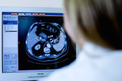 Los investigadores trabajan en un mejor tratamiento para el c&aacute;ncer de pr&oacute;stata agresivo