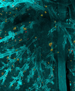 Los nuevos tratamientos consiguen una fuerte reducci&oacute;n de la tasa de mortalidad por c&aacute;ncer de pulm&oacute;n