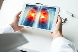 Prueban una terapia potencial que ha demostrado mejorar la eficacia de la inmunoterapia en el c&aacute;ncer de pulm&oacute;n