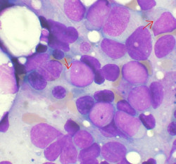 Un estudio revela una posible nueva diana para tratar la leucemia mieloide aguda