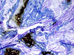 Un inhibidor de PARP reduce los tumores en pacientes con c&aacute;ncer de p&aacute;ncreas con mutaciones