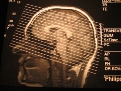 Un nuevo tratamiento diet&eacute;tico para la epilepsia es bien tolerado y reduce las convulsiones