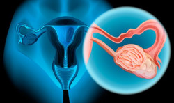 Un prometedor tratamiento para el c&aacute;ncer de ovario 