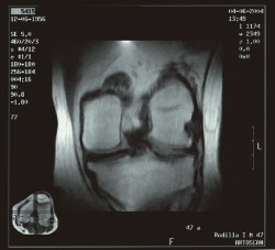 Un tratamiento no quir&uacute;rgico reduce r&aacute;pidamente el dolor de rodilla por artrosis y mejora la funci&oacute;n