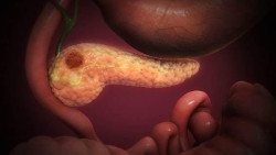 Una investigaci&oacute;n internacional buscar&aacute; las causas del c&aacute;ncer renal, pancre&aacute;tico y colorrectal