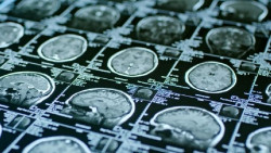 Una novedosa metodolog&iacute;a de resonancia magn&eacute;tica permite un nivel de an&aacute;lisis sin precedentes de las lesiones de ictus