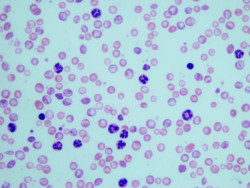 Una nueva t&eacute;cnica con c&eacute;lulas CAR-T logra la remisi&oacute;n de un tipo de leucemia fatal en dos adolescentes