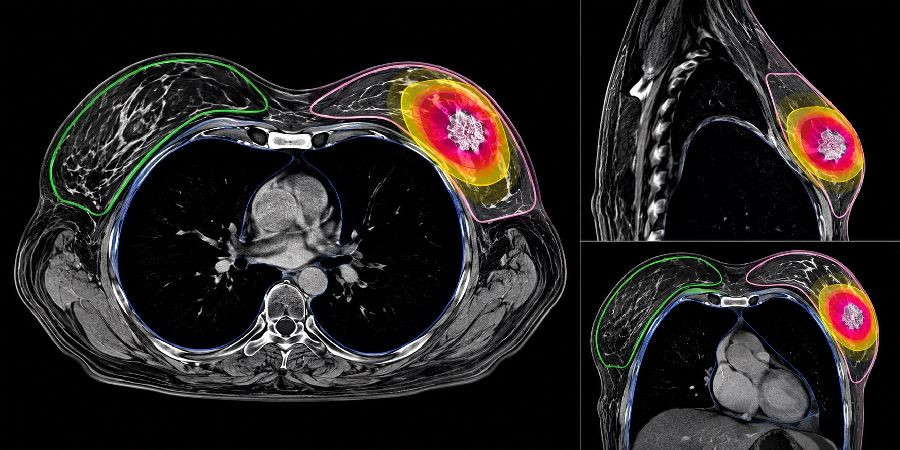 Una radioterapia de cinco d&iacute;as y m&iacute;nimo volumen muestra resultados favorables en pacientes con c&aacute;ncer de mama precoz