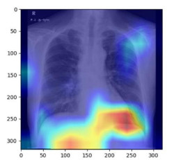 Valdecilla acoge este lunes una jornada sobre salud hep&aacute;tica y metab&oacute;lica